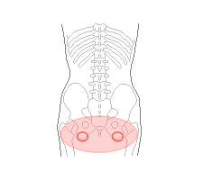 臀部の浮腫　坐骨部